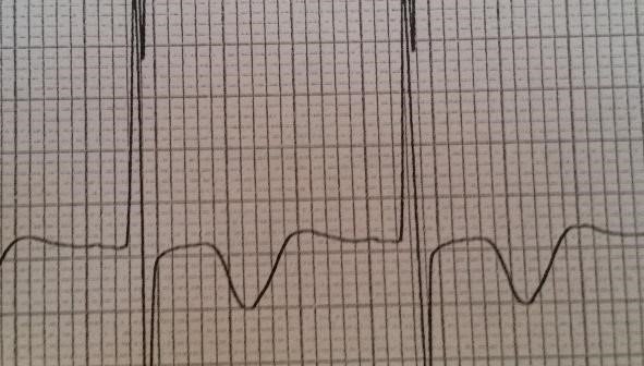 Wellens Syndrome: The Forgotten Diagnosis | ACOEP RSO