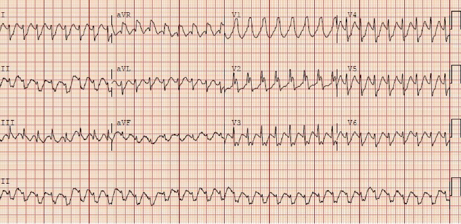 Flecainide Induced Atrial Flutter | ACOEP RSO